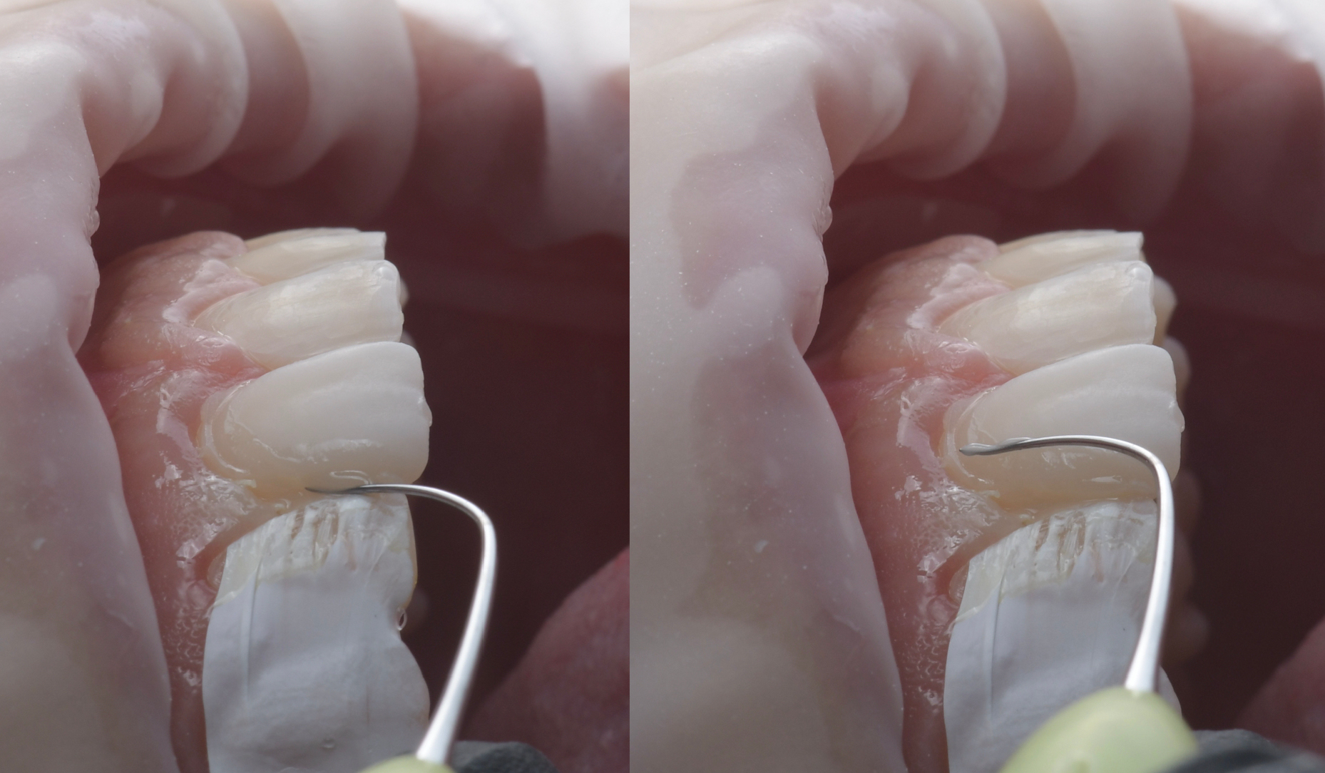 Figure 10: Flowable composite spreading and excess removal.
